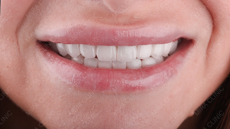 Hollywood smile final result